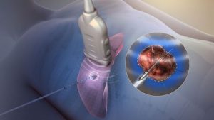 Radiofrequency Ablation Procedure Graphic