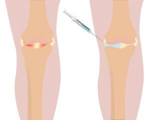 Viscosupplementation - Gel Shots - Network Spine