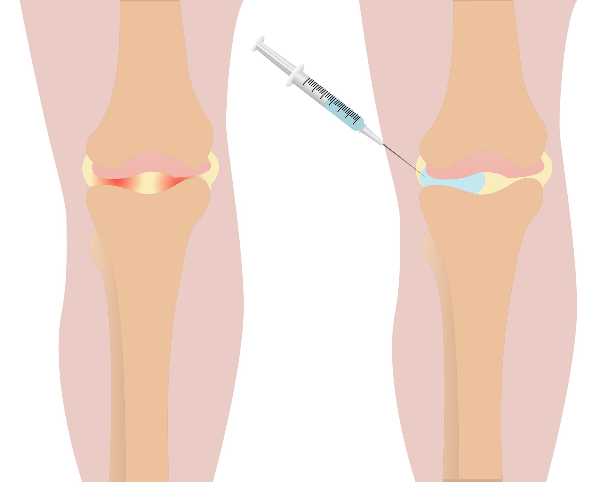 Hyaluronic Acid Injections How Do They Treat Arthritis